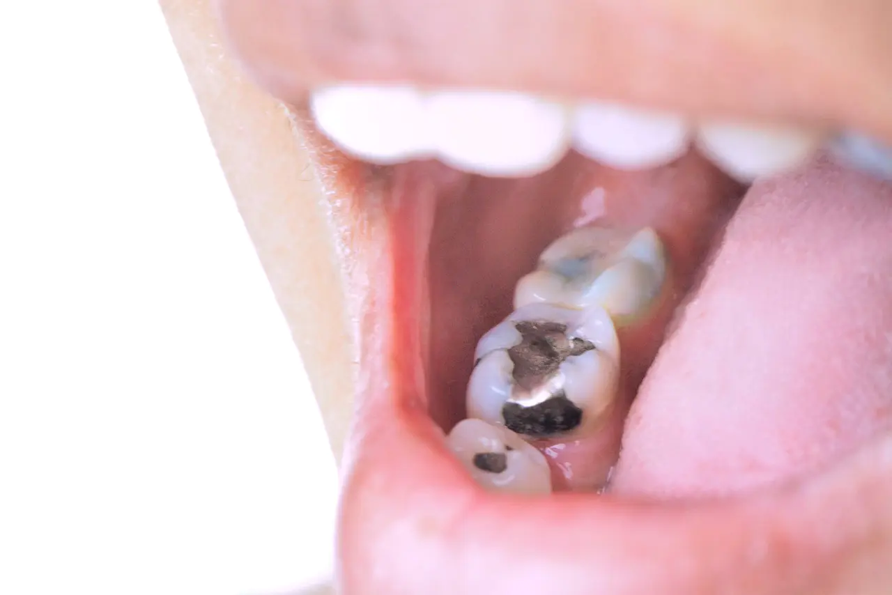 永遠の白い歯を手に入れる!虫歯・銀歯から卒業する究極の予防法